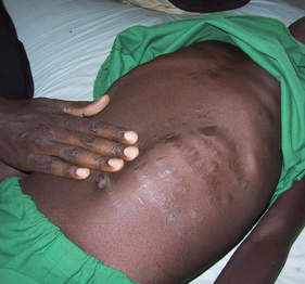 Visceral leishmaniasis East Africa 