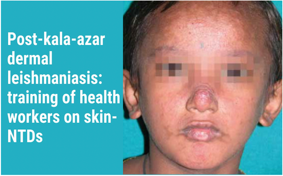 Post-kala-azar dermal leishmaniasis: training of health workers on skin-NTDs